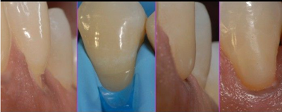 病例分享|下頜后牙牙槽嵴保存延期種植頰側骨壁吸收植骨引導骨再生一例 病例分享|下頜后牙牙槽嵴保存延期種植頰側骨壁吸收植骨引導骨再生一例