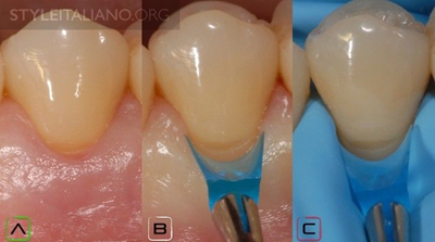 病例分享|下頜后牙牙槽嵴保存延期種植頰側骨壁吸收植骨引導骨再生一例 病例分享|下頜后牙牙槽嵴保存延期種植頰側骨壁吸收植骨引導骨再生一例