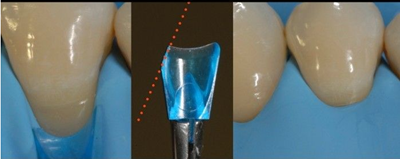 病例分享|下頜后牙牙槽嵴保存延期種植頰側骨壁吸收植骨引導骨再生一例 病例分享|下頜后牙牙槽嵴保存延期種植頰側骨壁吸收植骨引導骨再生一例