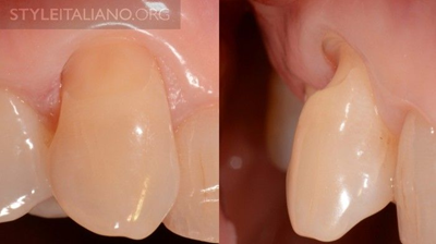 病例分享|下頜后牙牙槽嵴保存延期種植頰側骨壁吸收植骨引導骨再生一例 病例分享|下頜后牙牙槽嵴保存延期種植頰側骨壁吸收植骨引導骨再生一例