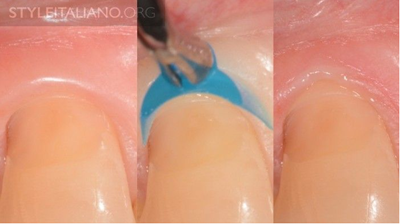 病例分享|下頜后牙牙槽嵴保存延期種植頰側骨壁吸收植骨引導骨再生一例 病例分享|下頜后牙牙槽嵴保存延期種植頰側骨壁吸收植骨引導骨再生一例