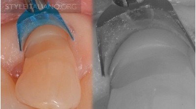 病例分享|下頜后牙牙槽嵴保存延期種植頰側骨壁吸收植骨引導骨再生一例 病例分享|下頜后牙牙槽嵴保存延期種植頰側骨壁吸收植骨引導骨再生一例