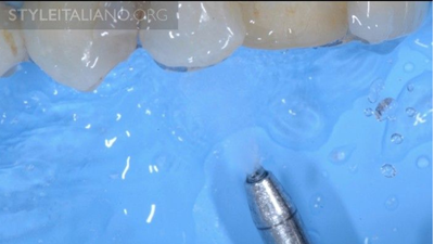 病例分享|下頜后牙牙槽嵴保存延期種植頰側骨壁吸收植骨引導骨再生一例 病例分享|下頜后牙牙槽嵴保存延期種植頰側骨壁吸收植骨引導骨再生一例