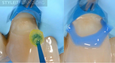 病例分享|下頜后牙牙槽嵴保存延期種植頰側骨壁吸收植骨引導骨再生一例 病例分享|下頜后牙牙槽嵴保存延期種植頰側骨壁吸收植骨引導骨再生一例