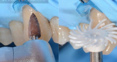 病例分享|下頜后牙牙槽嵴保存延期種植頰側骨壁吸收植骨引導骨再生一例 病例分享|下頜后牙牙槽嵴保存延期種植頰側骨壁吸收植骨引導骨再生一例