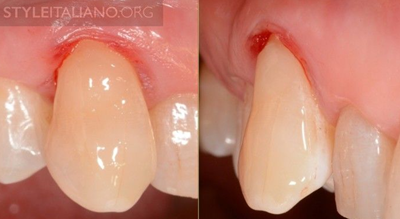 病例分享|下頜后牙牙槽嵴保存延期種植頰側骨壁吸收植骨引導骨再生一例 病例分享|下頜后牙牙槽嵴保存延期種植頰側骨壁吸收植骨引導骨再生一例