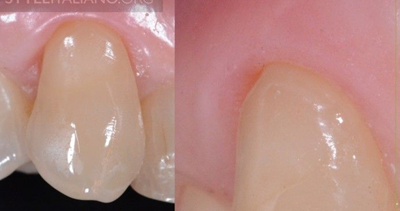 病例分享|下頜后牙牙槽嵴保存延期種植頰側骨壁吸收植骨引導骨再生一例 病例分享|下頜后牙牙槽嵴保存延期種植頰側骨壁吸收植骨引導骨再生一例