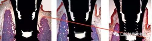 牙科種植 牙科種植