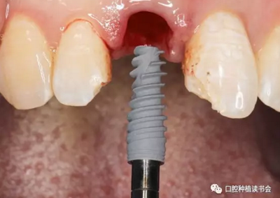 牙科種植 牙科種植
