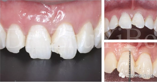 牙科種植 牙科種植