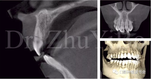 牙科種植 牙科種植