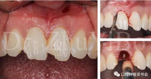 牙科種植 牙科種植