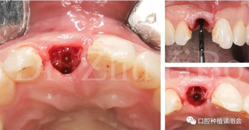 牙科種植 牙科種植