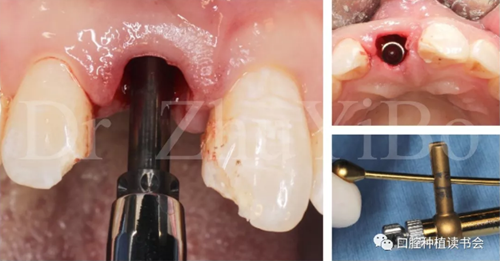 牙科種植 牙科種植