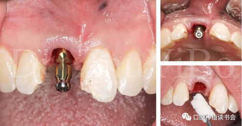 牙科種植 牙科種植