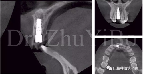 牙科種植 牙科種植