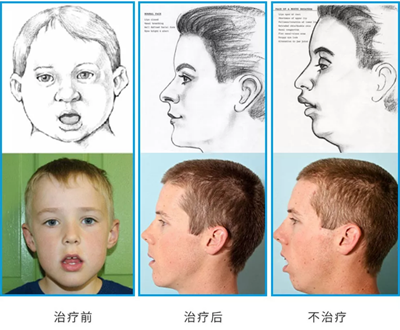 兒童早期矯治問(wèn)題 兒童早期矯治問(wèn)題