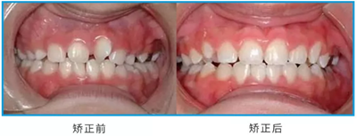 兒童早期矯治問(wèn)題 兒童早期矯治問(wèn)題