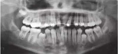 【病例分享】上頜中切牙區(qū)外傷的自體移植和正畸治療 【病例分享】上頜中切牙區(qū)外傷的自體移植和正畸治療