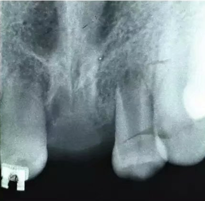【病例分享】上頜中切牙區(qū)外傷的自體移植和正畸治療 【病例分享】上頜中切牙區(qū)外傷的自體移植和正畸治療
