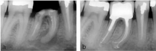 宇森SC-Pro鎳鈦根管銼|宇森醫(yī)療根管治療器械領(lǐng)跑者 宇森SC-Pro鎳鈦根管銼|宇森醫(yī)療根管治療器械領(lǐng)跑者