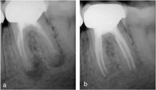 宇森SC-Pro鎳鈦根管銼|宇森醫(yī)療根管治療器械領(lǐng)跑者 宇森SC-Pro鎳鈦根管銼|宇森醫(yī)療根管治療器械領(lǐng)跑者