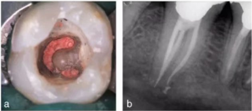 宇森SC-Pro鎳鈦根管銼|宇森醫(yī)療根管治療器械領(lǐng)跑者 宇森SC-Pro鎳鈦根管銼|宇森醫(yī)療根管治療器械領(lǐng)跑者