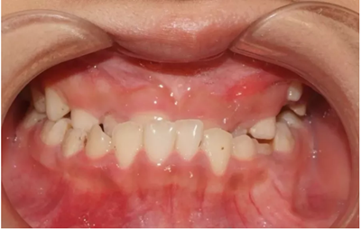 正畸矯正 正畸矯正