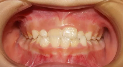 正畸矯正 正畸矯正