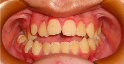 正畸矯正 正畸矯正