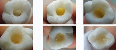 各類(lèi)洞形的樹(shù)脂充填方法 各類(lèi)洞形的樹(shù)脂充填方法