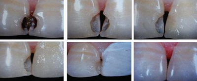 各類(lèi)洞形的樹(shù)脂充填方法 各類(lèi)洞形的樹(shù)脂充填方法