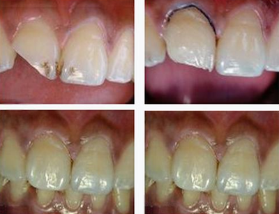 各類(lèi)洞形的樹(shù)脂充填方法 各類(lèi)洞形的樹(shù)脂充填方法