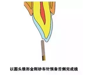 貼面?zhèn)溲乐嗌伲? alt=