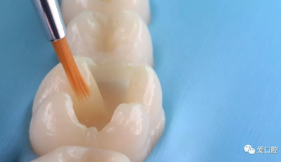 復(fù)合樹脂直接粘接牙體修復(fù)技術(shù)臨床常見問題及處理 復(fù)合樹脂直接粘接牙體修復(fù)技術(shù)臨床常見問題及處理