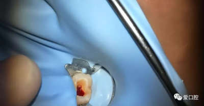 復(fù)合樹脂直接粘接牙體修復(fù)技術(shù)臨床常見問題及處理 復(fù)合樹脂直接粘接牙體修復(fù)技術(shù)臨床常見問題及處理