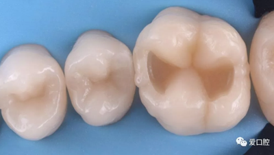 復(fù)合樹脂直接粘接牙體修復(fù)技術(shù)臨床常見問題及處理 復(fù)合樹脂直接粘接牙體修復(fù)技術(shù)臨床常見問題及處理