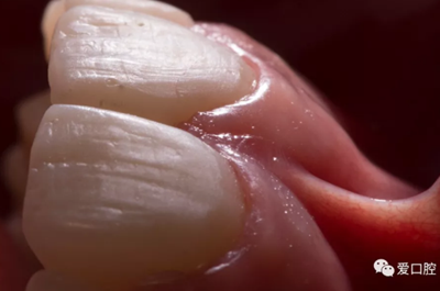 復(fù)合樹脂直接粘接牙體修復(fù)技術(shù)臨床常見問題及處理 復(fù)合樹脂直接粘接牙體修復(fù)技術(shù)臨床常見問題及處理