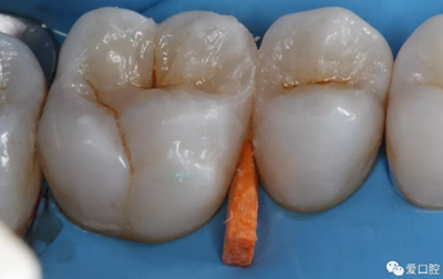 復(fù)合樹脂直接粘接牙體修復(fù)技術(shù)臨床常見問題及處理 復(fù)合樹脂直接粘接牙體修復(fù)技術(shù)臨床常見問題及處理