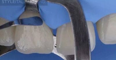 【分享】前翼技術(shù)關(guān)閉前牙間隙