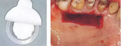 【牙周外科的基本技術(shù)技能】術(shù)后管理 【牙周外科的基本技術(shù)技能】術(shù)后管理