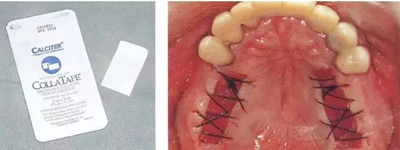 【牙周外科的基本技術(shù)技能】術(shù)后管理 【牙周外科的基本技術(shù)技能】術(shù)后管理