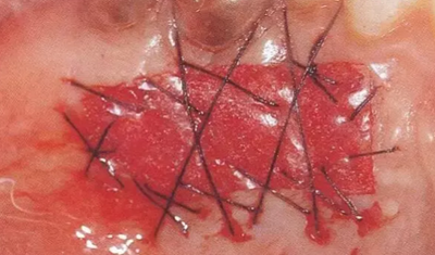 【牙周外科的基本技術(shù)技能】術(shù)后管理 【牙周外科的基本技術(shù)技能】術(shù)后管理