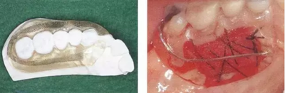 【牙周外科的基本技術(shù)技能】術(shù)后管理 【牙周外科的基本技術(shù)技能】術(shù)后管理