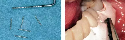 【牙周外科的基本技術(shù)技能】術(shù)后管理 【牙周外科的基本技術(shù)技能】術(shù)后管理