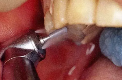 【牙周外科的基本技術(shù)技能】術(shù)后管理 【牙周外科的基本技術(shù)技能】術(shù)后管理