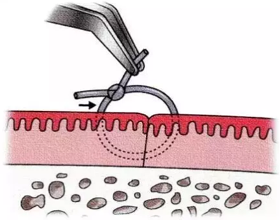 【牙周外科的基本技術(shù)技能】術(shù)后管理 【牙周外科的基本技術(shù)技能】術(shù)后管理