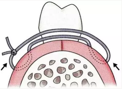 【牙周外科的基本技術(shù)技能】術(shù)后管理 【牙周外科的基本技術(shù)技能】術(shù)后管理