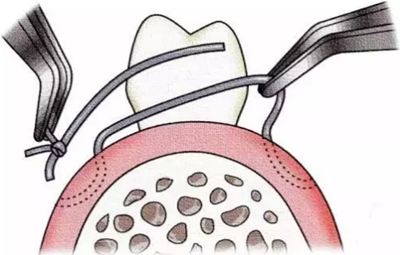 【牙周外科的基本技術(shù)技能】術(shù)后管理 【牙周外科的基本技術(shù)技能】術(shù)后管理