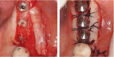 種植體周圍角化齦的獲得時期與方法 種植體周圍角化齦的獲得時期與方法